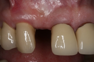 Houston dental implant front tooth
