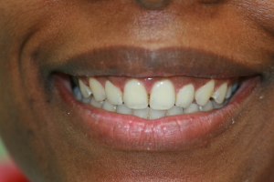 gummy smile fixed by crown lengthening